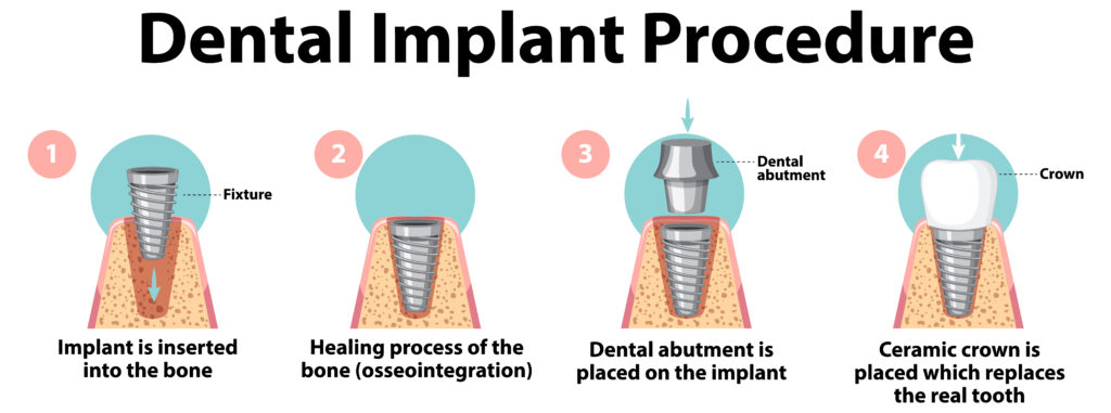 a brief and descriptive graphic about the 4 steps in a dental implant process